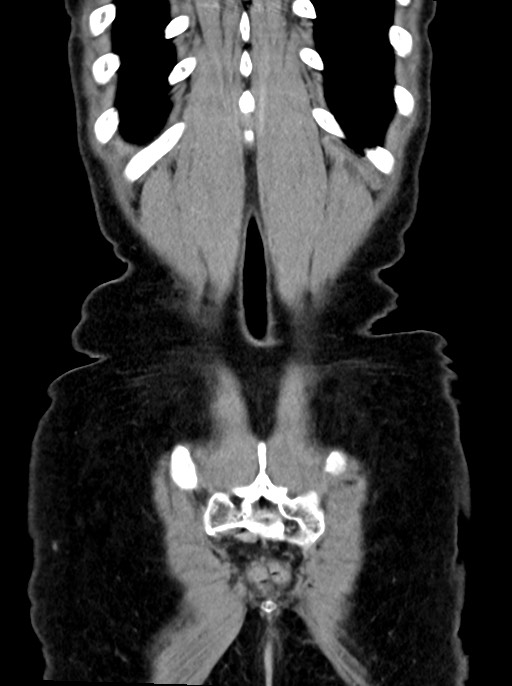 Abdominal wall and retroperitoneal tuberculosis (Radiopaedia 88137-104729 Coronal C+ portal venous phase 94).jpg