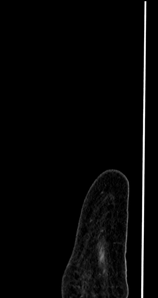 Abdominal wall and retroperitoneal tuberculosis (Radiopaedia 88137-104729 Sagittal C+ portal venous phase 2).jpg