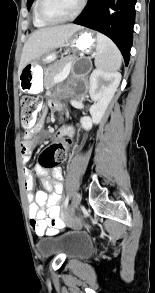 Abdominal wall and retroperitoneal tuberculosis (Radiopaedia 88137-104729 Sagittal C+ portal venous phase 56).jpg