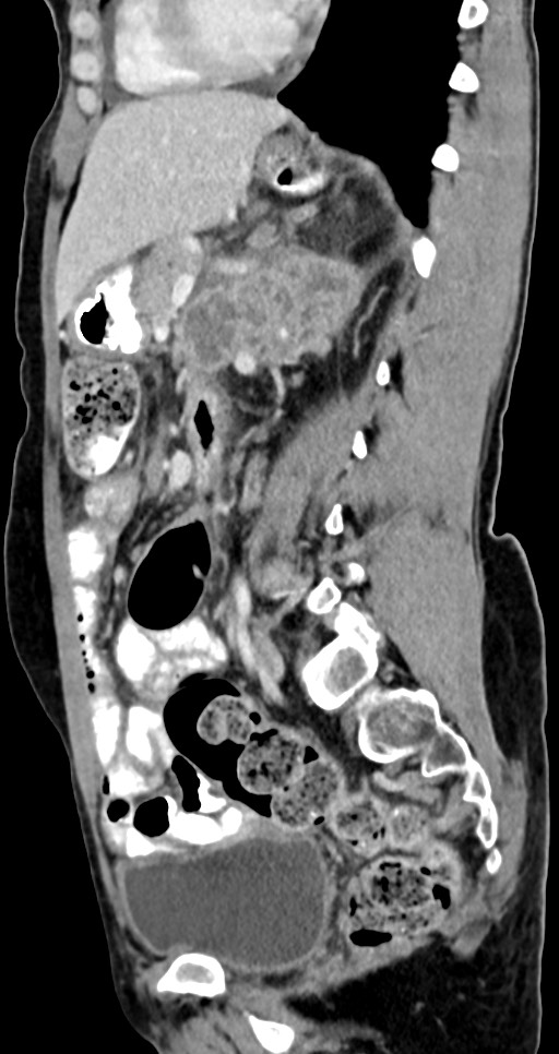 Abdominal wall and retroperitoneal tuberculosis (Radiopaedia 88137-104729 Sagittal C+ portal venous phase 64).jpg