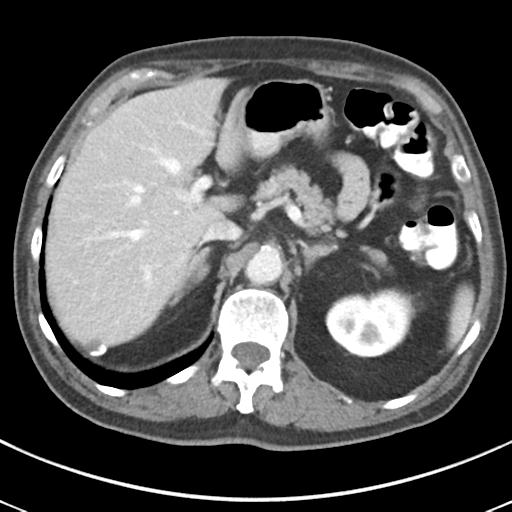 Abdominal wall metastasis from colorectal carcinoma (Radiopaedia 31016-31717 Axial C+ portal venous phase 21).jpg