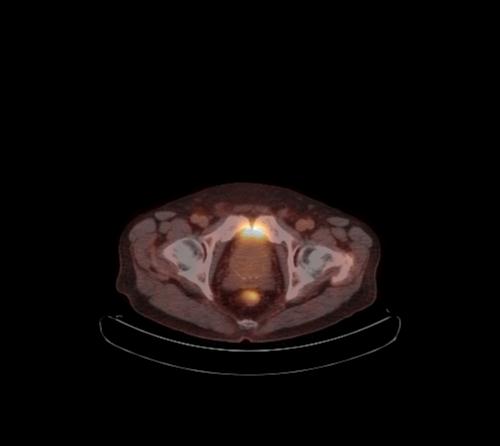 File:Abdominal wall metastasis from colorectal carcinoma (Radiopaedia 31016-31719 C 24).jpg