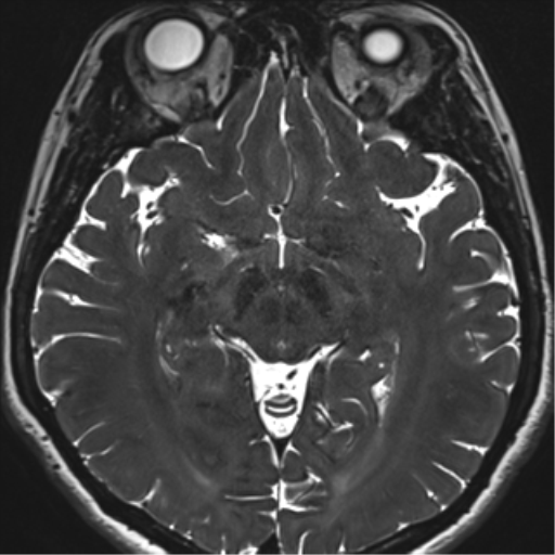 File:Abducens nerve palsy (Radiopaedia 51069-56648 Axial T2 fat sat 78).png