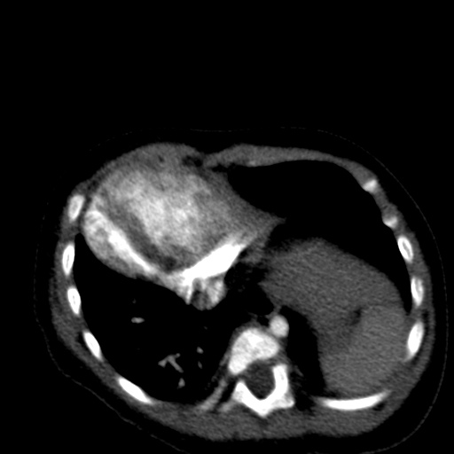 File:Aberrant left pulmonary artery (pulmonary sling) (Radiopaedia 42323-45435 Axial C+ CTPA 34).jpg