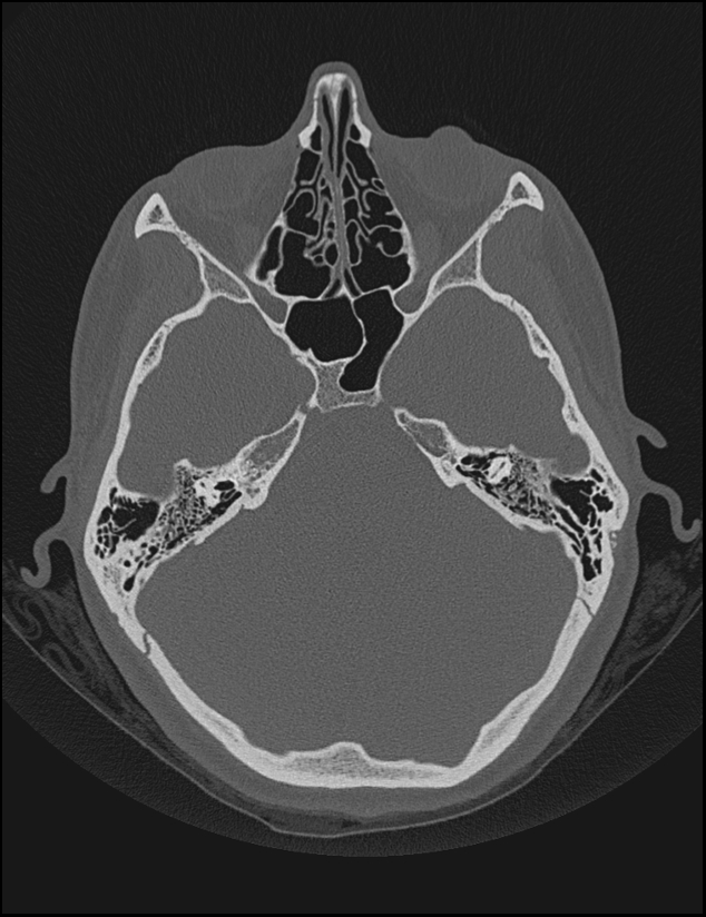 Aberrant right internal carotid artery (Radiopaedia 65191-74198 Axial non-contrast 55).jpg
