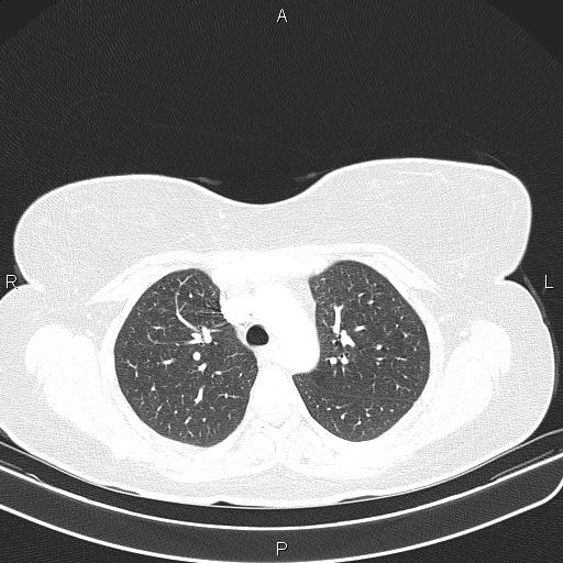 Aberrant right subclavian artery (Radiopaedia 87334-103629 Axial lung window 23).jpg