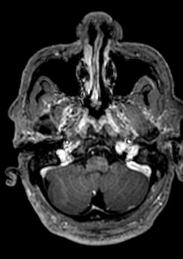 Accessory middle cerebral artery (Radiopaedia 73114-83828 Axial T1 C+ 159).jpg
