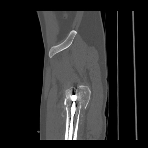 File:Acetabular and ilial fractures (Radiopaedia 59084-66378 Sagittal bone window 90).jpg