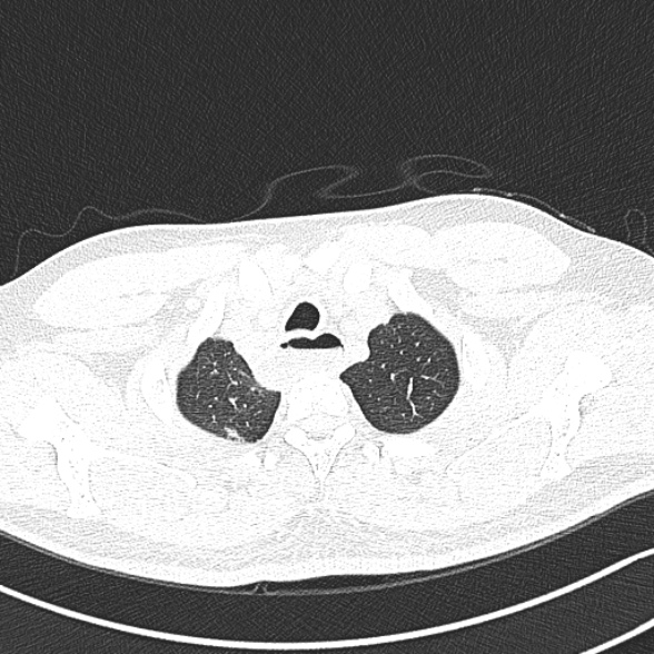 Achalasia with aspiration (Radiopaedia 55413-61845 Axial lung window 7).jpg