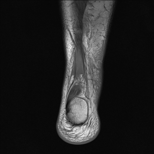 File:Achilles tendon tear (Radiopaedia 77615-89819 Coronal T1 25).jpg