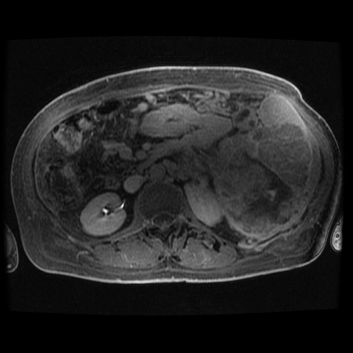 Acinar cell carcinoma of the pancreas (Radiopaedia 75442-86668 Axial late phase (~30 mins) 38).jpg