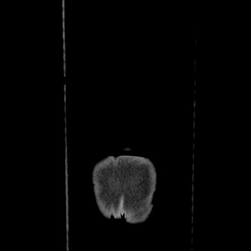 Acinar cell carcinoma of the pancreas (Radiopaedia 75442-86669 Coronal C+ portal venous phase 128).jpg