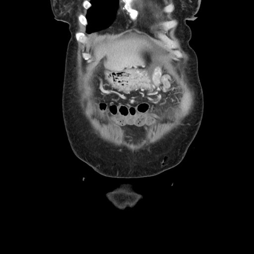 Acinar cell carcinoma of the pancreas (Radiopaedia 75442-86669 Coronal C+ portal venous phase 19).jpg