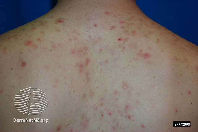 File:Acne affecting the back images (DermNet NZ acne-acne-back-183).jpg