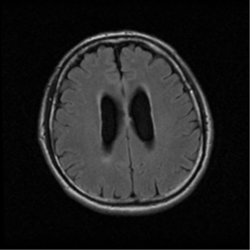 File:Acoustic schwannoma (Radiopaedia 39170-41387 Axial FLAIR 15).png