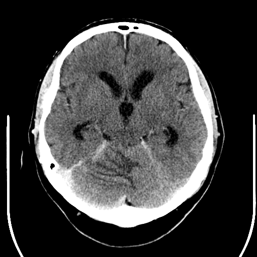 File:Acoustic schwannoma (Radiopaedia 39170-41389 Axial C+ 11).png