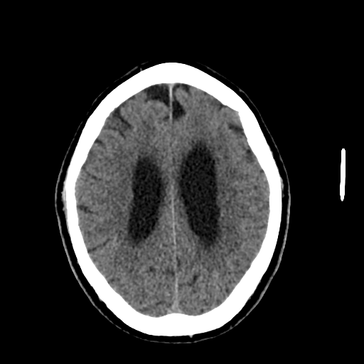 File:Acoustic schwannoma (Radiopaedia 55729-62280 Axial non-contrast 24).png