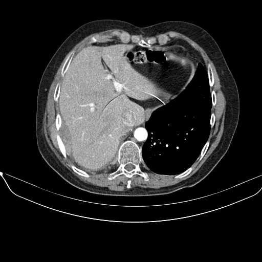 File:Acquired adrenal hyperplasia - due to thymic carcinoid tumor (Radiopaedia 21269-21184 C+ arterial phase 3).jpg