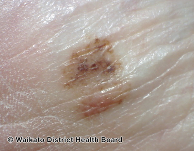 File:Acral lentiginous melanoma 3 macro (DermNet NZ alm-3-macro).jpg