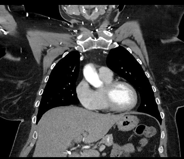 Acromioclavicular joint cyst (Radiopaedia 58455-65610 Coronal C+ arterial phase 57).jpg