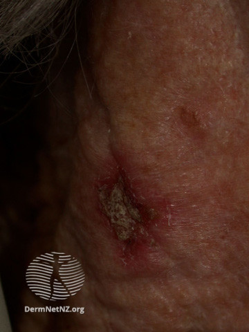 File:Actinic Keratoses treated with imiquimod (DermNet NZ lesions-ak-imiquimod-3767).jpg