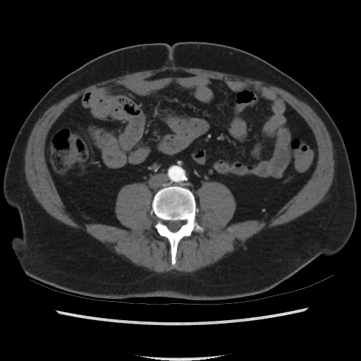 File:Active colonic bleed on CT (Radiopaedia 49765-55025 Axial C+ arterial phase 48).jpg