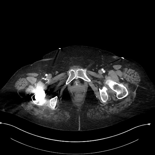 Active renal extravasation with large subcapsular and retroperitoneal hemorrhage (Radiopaedia 60975-68796 Axial C+ arterial phase 199).jpg