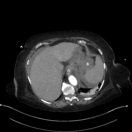 Active renal extravasation with large subcapsular and retroperitoneal hemorrhage (Radiopaedia 60975-68796 Axial C+ arterial phase 36).jpg