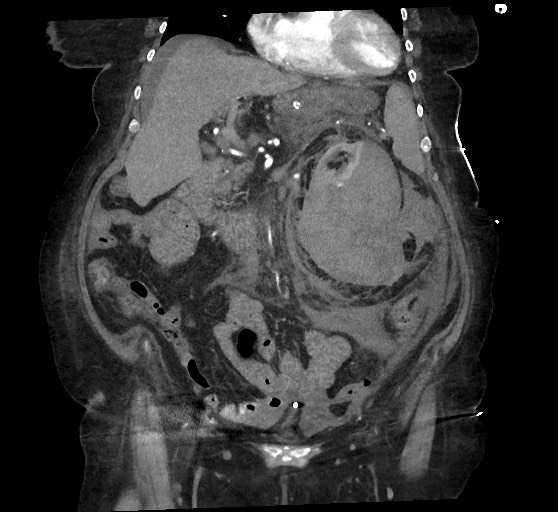 Active renal extravasation with large subcapsular and retroperitoneal hemorrhage (Radiopaedia 60975-68796 Coronal C+ arterial phase 66).jpg