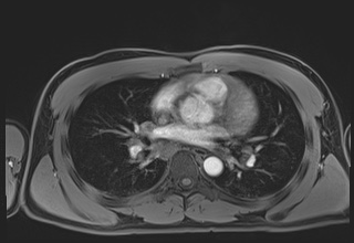 File:Active right ventricular cardiac sarcoidosis (Radiopaedia 55596-62100 Axial Post contrast Dixon 36).jpg