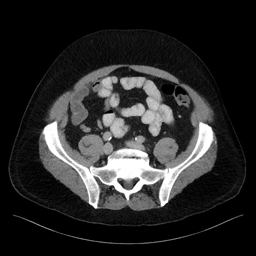 Acute-on-chronic pancreatitis (Radiopaedia 67286-76656 Axial C+ portal venous phase 58).jpg