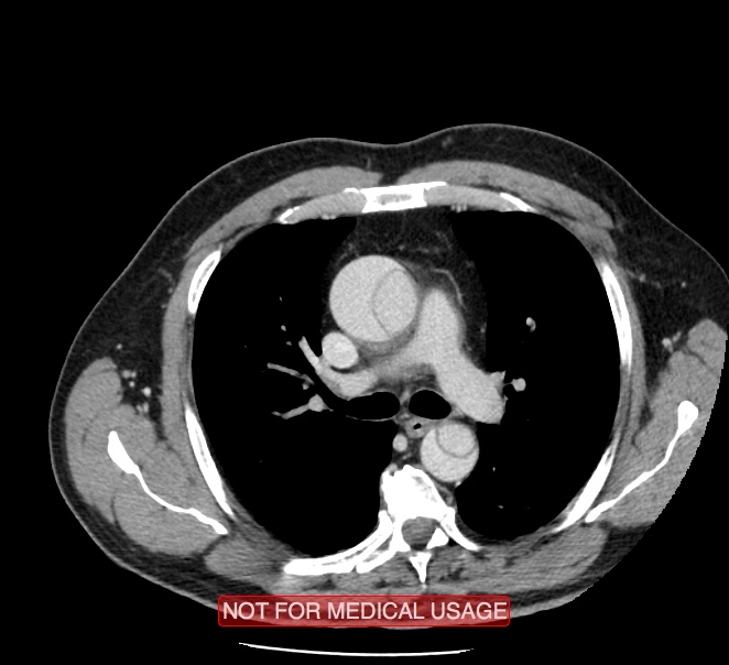Acute aortic dissection - Stanford type A (Radiopaedia 40661-43285 Axial C+ portal venous phase 16).jpg