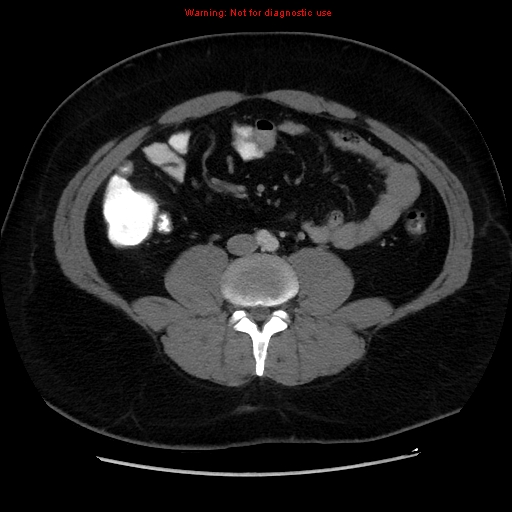 File:Acute appendicitis (Radiopaedia 12326-12607 Axial C+ portal venous phase 6).jpg