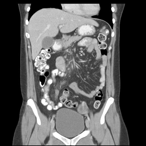 Acute appendicitis (Radiopaedia 30297-30934 Coronal C+ portal venous phase 18).jpg