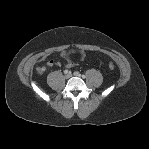 Acute appendicitis (Radiopaedia 48511-53463 Axial C+ portal venous phase 69).jpg