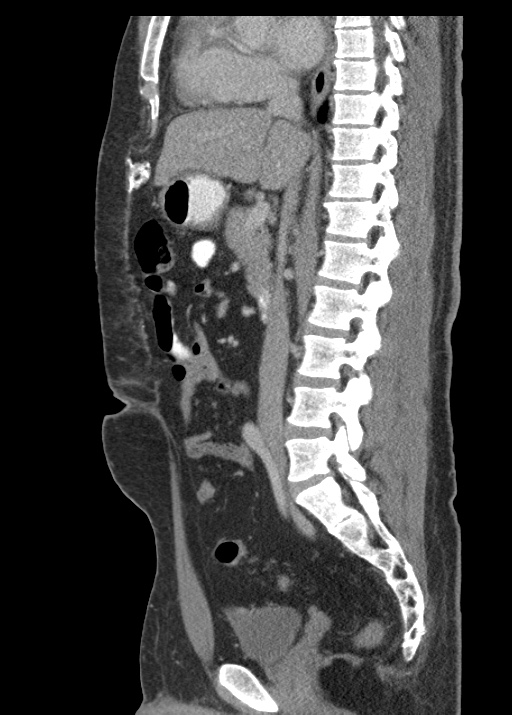 Acute appendicitis (Radiopaedia 48511-53463 Sagittal C+ portal venous phase 68).jpg