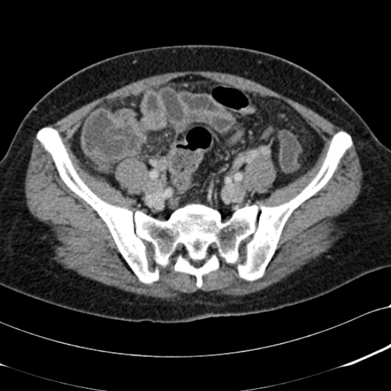 Acute appendicitis (Radiopaedia 48792-53822 Axial C+ portal venous phase 86).jpg