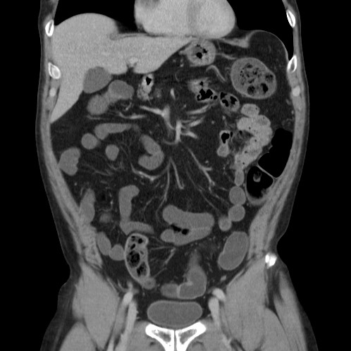 File:Acute appendicitis (Radiopaedia 66513-75790 Coronal C+ portal venous phase 21).jpg