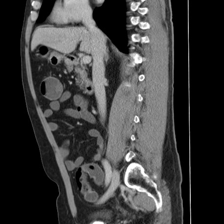 File:Acute appendicitis (Radiopaedia 66513-75790 Sagittal C+ portal venous phase 67).jpg