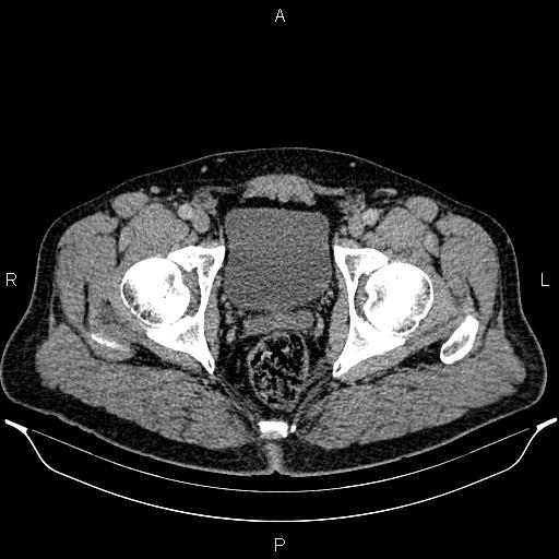 Acute appendicitis (Radiopaedia 84780-100240 Axial C+ portal venous phase 105).jpg