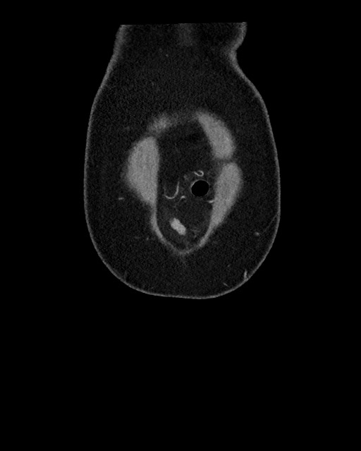 Acute appendicitis - large appendicoliths (Radiopaedia 61805-69820 Coronal C+ portal venous phase 12).jpg