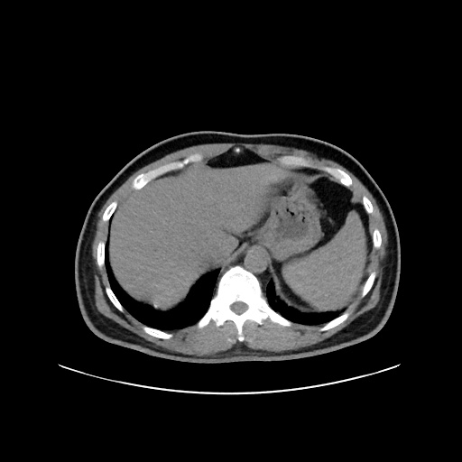File:Acute appendicitis and COVID 19 pneumonia (Radiopaedia 76604-88380 Axial non-contrast 51).jpg