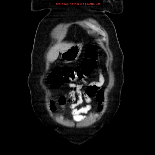 File:Acute appendicitis complicated by ovarian vein thrombophlebitis (Radiopaedia 16172-15851 Coronal C+ portal venous phase 15).jpg