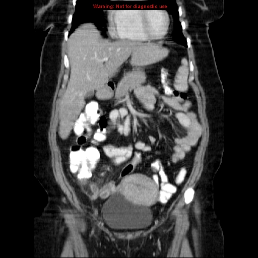 Acute appendicitis complicated by ovarian vein thrombophlebitis (Radiopaedia 16172-15851 Coronal C+ portal venous phase 31).jpg