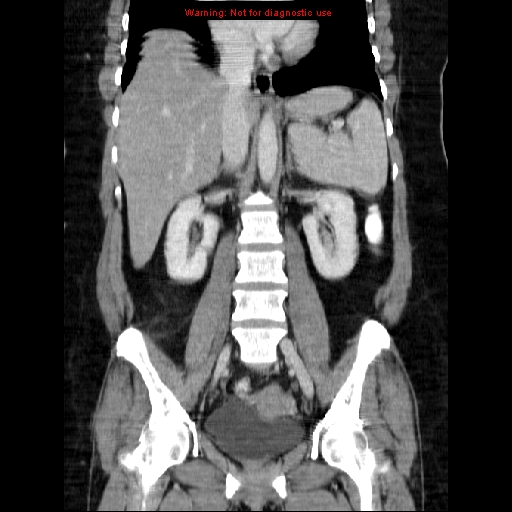 Acute appendicitis complicated by ovarian vein thrombophlebitis (Radiopaedia 16172-15851 Coronal C+ portal venous phase 48).jpg