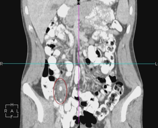 File:Acute appendicitis with CT arrowhead sign (Radiopaedia 21474-21411 Coronal C+ portovenous phase (annotated) 1).jpg