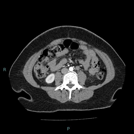 File:Acute bilateral pyelonephritis (Radiopaedia 37146-38881 Axial C+ arterial phase 109).jpg