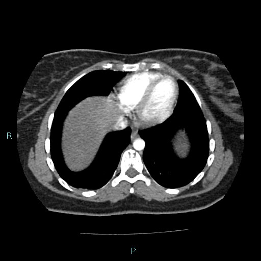 File:Acute bilateral pyelonephritis (Radiopaedia 37146-38881 Axial C+ arterial phase 5).jpg