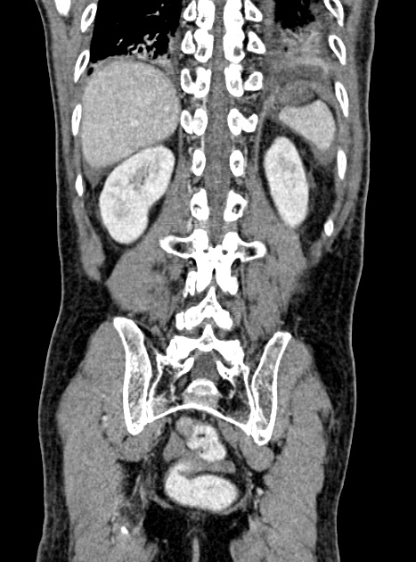 Acute bowel ischemia (Radiopaedia 87695-104114 Coronal C+ portal venous phase 296).jpg