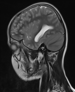 File:Acute cerebellar ataxia (Radiopaedia 61487-69446 Sagittal T2 1).jpg